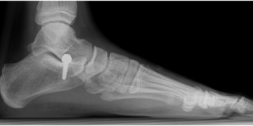 عملية جراحية في السعودية  أولى من نوعها لتصحيح  انحراف في قدم مريض..  والوزارة تدعو الأطباء للمشاركة  في ملتقى الصحة العالمي…