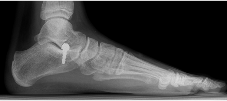 عملية جراحية في السعودية أولى من نوعها لتصحيح انحراف في قدم مريض.. والوزارة تدعو الأطباء للمشاركة في ملتقى الصحة العالمي…