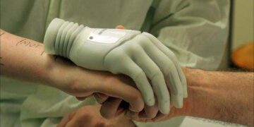 انقاذ يد ثلاثيني من البتر  أصيبت في حادث سقوط  من ارتفاع 3 أمتار  على قطع حديدية…