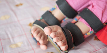 6 عمليات متتابعة في 3 ساعات  أعادت الحركة لطفل سعودي  أُصيب بشلل رباعي…