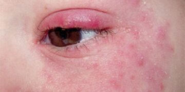 قديماً أعيد سببه الى لدغة الذئب!  المرض المناعي الذاتي “الذئبة”  في الطريق الى العلاج  إذا نجحت تجارب فريق  من العلماء الإستراليين…