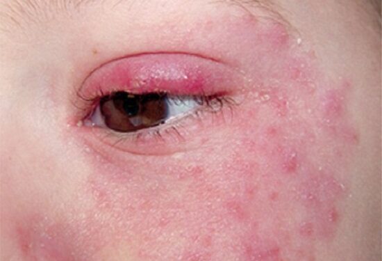 قديماً أعيد سببه الى لدغة الذئب!  المرض المناعي الذاتي “الذئبة”  في الطريق الى العلاج  إذا نجحت تجارب فريق  من العلماء الإستراليين…