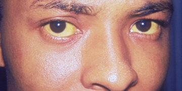 منظمة الصحة العالمية تُحذّر:التهاب الكبد الفيروسي B و Cشرّ يتربّص بالبشريةوعدد المتوفين به الى ازدياد…