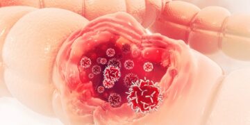 تجنباً لنمو سرطان القولون والمستقيم.. الأطباء عدلوا مواعيد إجراء التنظير: يجب البدء به في سن الأربعين والأفضل من العشرين حتى الثمانين والمرأة كالرجل غير معفاة…