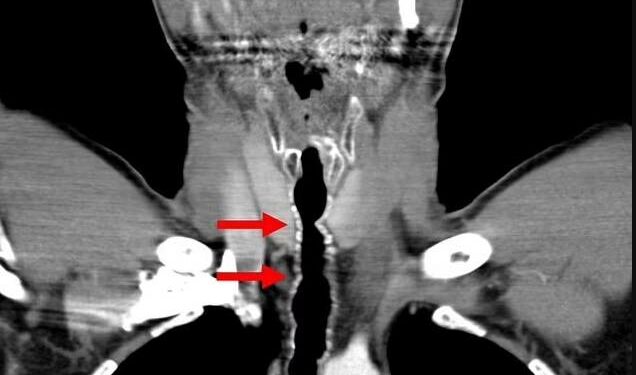 بسبب شراهته للـسجائرطوال 32 عاماً…نمساوي يتفاجأ بشعرينمو في حلقه ما توقّفالا بعد توقّفه عن التدخين…