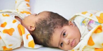 توأم أرتري ملتصق من ناحية الرأسفُصل بنجاح في السعوديةحاملاً الرقم 64 في عدادالتوائم المفصولَيْن من 37 دولة  …