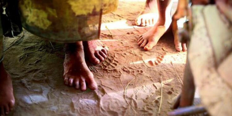 منظمة الصحة العالمية تتعقّبالورم الفطري Mycetomeوترشد الناس للوقاية منه…