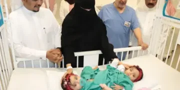 أدق عملية لفصل توأم سعودي:  جراحة على 9 مراحل خلال 15 ساعة  بمساعدة فريق من 38 فرداًمن اختصاصات مختلفة…