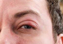 مصر تنجح في التخلّص من التراخوما!