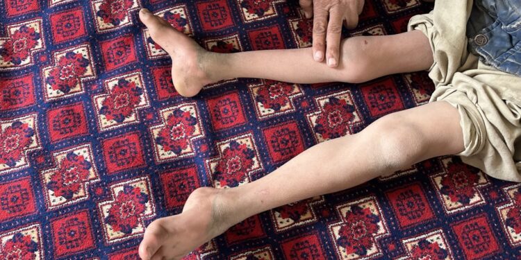 مبادرة لإستئصال شلل الأطفالبالتعاون مع مؤسسةمحمد بن زايد للأثر الإنساني...