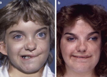 ورشة عمل عن التشوّهات الخلقيةبرعاية وزارة الصحة و مشاركة إختصاصيين :الحصانة بالوقاية والكشف المبكر ...