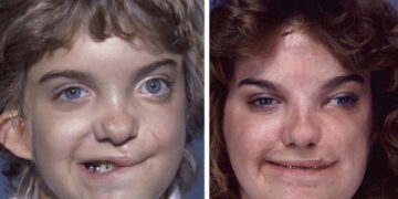 ورشة عمل عن التشوّهات الخلقية برعاية وزارة الصحة و مشاركة إختصاصيين : الحصانة بالوقاية والكشف المبكر …