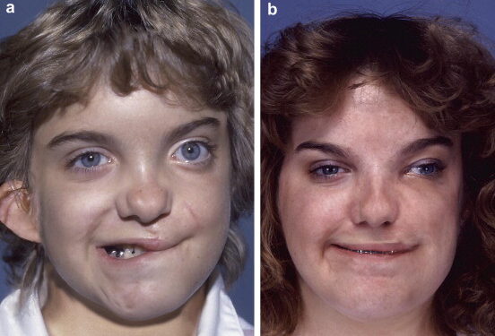 ورشة عمل عن التشوّهات الخلقيةبرعاية وزارة الصحة و مشاركة إختصاصيين :الحصانة بالوقاية والكشف المبكر ...