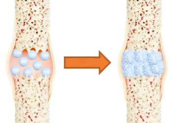 مادة مبتكرة من الصوف لعلاج كسور العظام