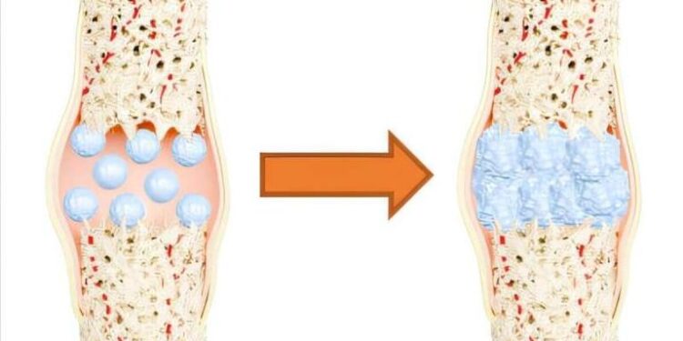 مادة مبتكرة من الصوف لعلاج كسور العظام