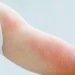 الأرتكاريا...مفاهيم خاطئةوخيارات علاجية حديثة